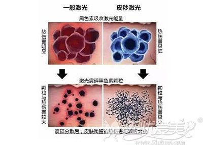 清远华美的皮秒激光综合祛斑的优势