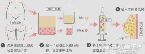 自体脂肪丰胸后吃什么存活率高？成都天姿建议食物+保养