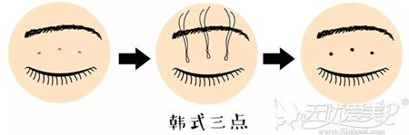 韩式三点双眼皮手术