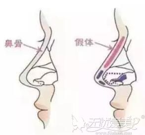 隆鼻假体的放置位置