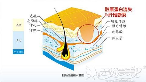 福州玛恩修复凹陷型疤痕