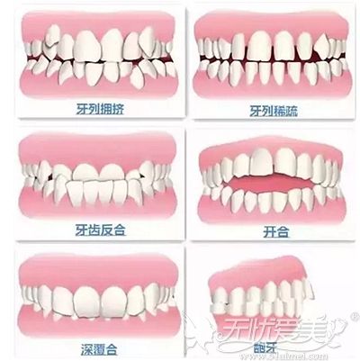 需要做牙齿矫正的几种类型