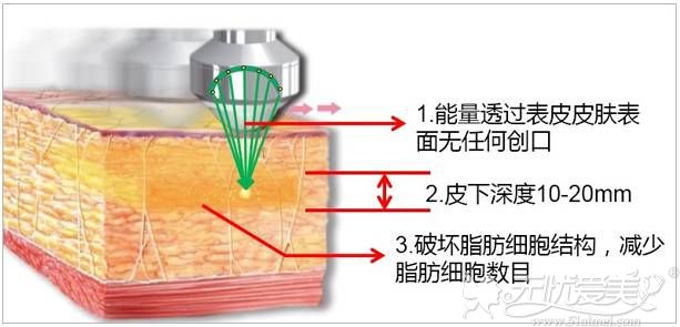 扬州美贝尔做SX导航吸脂