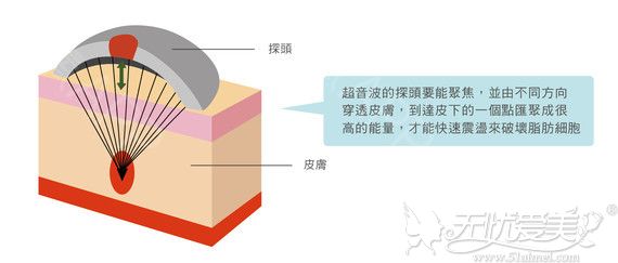 扬州美贝尔超声波吸脂