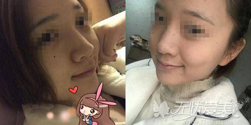 硅胶隆鼻后半个月