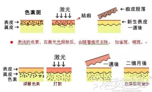 鹰潭美嘉整形激光去雀斑