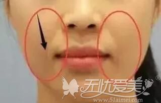 鼻唇沟凹陷做玻尿酸填充效果自然吗?北京哪家医院做的好?