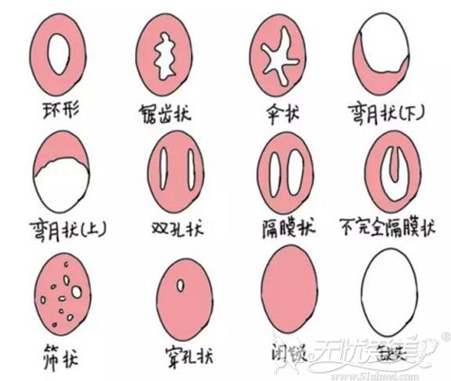 处女膜的各种形状