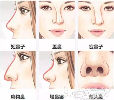 各种不好看的鼻型都会影响整个面部的颜值