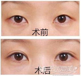 北京雅靓整形双眼皮术前术后效果
