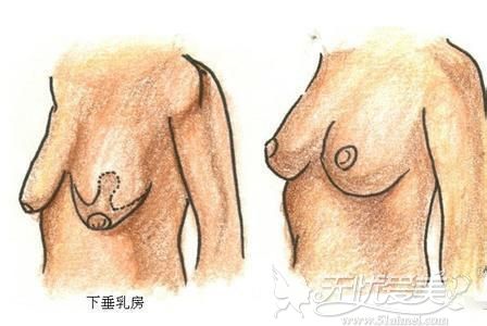 潮州博兰雅乳房下垂提升