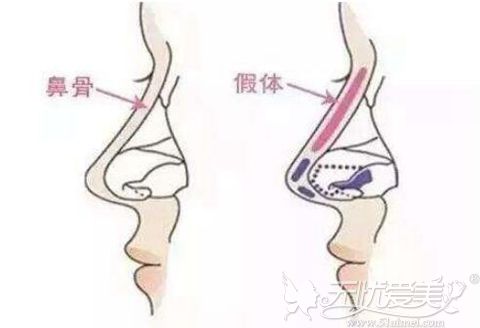 美莱假体隆鼻优势