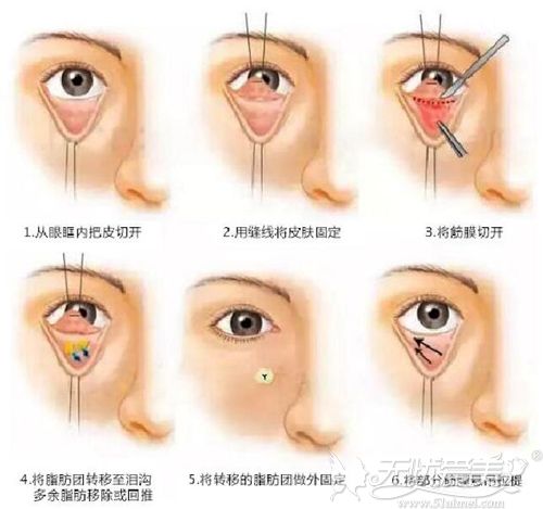 眶隔脂肪释放法祛眼袋原理