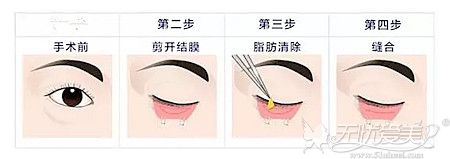 鸡西御美楼内切去眼袋的手术原理