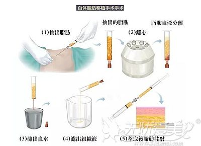 广州高尚自体脂肪的抽取的过程