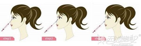 注射隆鼻的手术过程