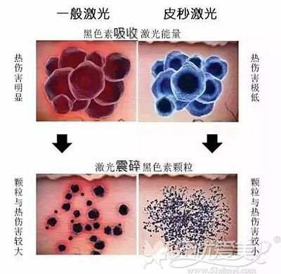 皮秒激光祛斑和不同激光祛斑的区别