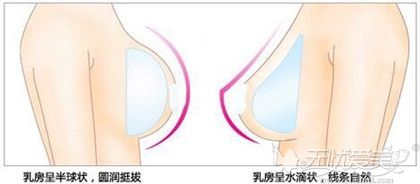 隆胸假体形状圆形和水滴型的区别