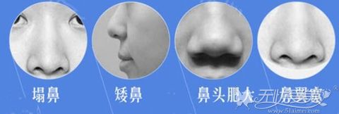 从王旭东介绍及肋软骨隆鼻案例知晓北京美莱隆鼻效果好吗?