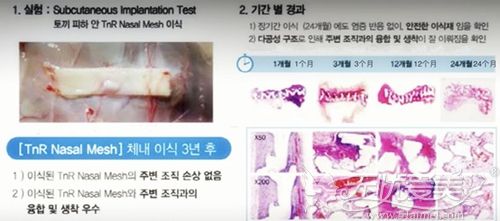 韩国纯真的mesh隆鼻怎么样 有没有案例可以做参考？