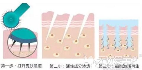 微针美塑皮肤管理