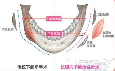 上海愉悦美联臣下颌角截骨术过程