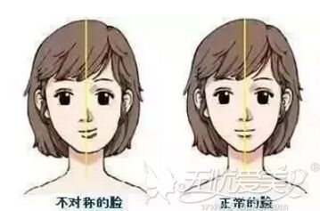 偏颌导致脸型不对称