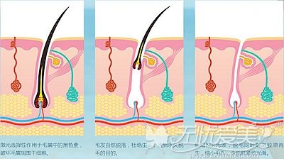 阜阳微悦激光脱毛的原理