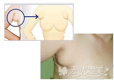 湛江哪个医院做副乳切除好?专业华美用案例和价格吸引你