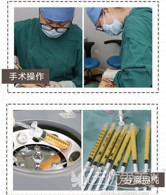 深圳艺星整形面部纳米脂肪移植3.0填充术