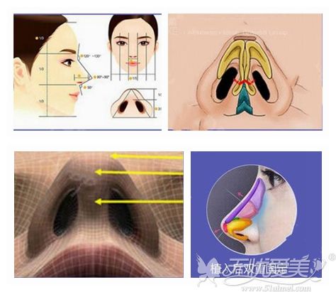 北京美莱膨体仿生隆鼻贵不贵?7月购买鼻整形项目免费送膨体