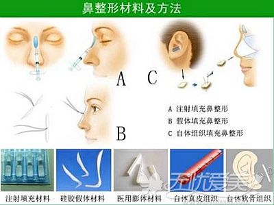 隆鼻的手术材料和方法