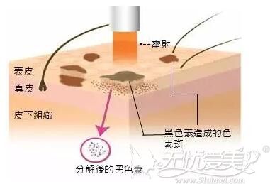 长沙雅美激光祛斑