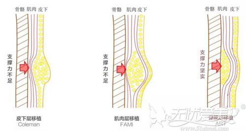 自体脂肪骨性移植技术原理