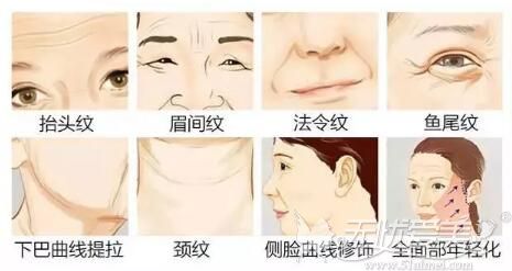 线雕可以改善面部皮肤衰老状态