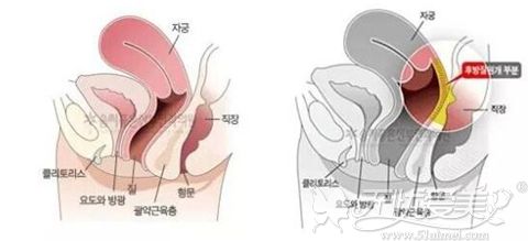 韩国好手艺后方膣圆盖术