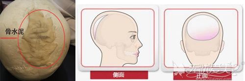 韩国雕刻后脑勺骨水泥填充原理