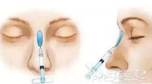 玻尿酸隆鼻的原理