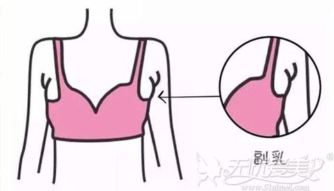 副乳是一般在腋下出现的多余的脂肪