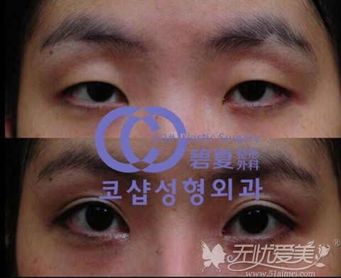 韩国碧夏双眼皮手术案例
