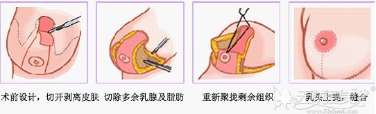 乳房缩小术原理