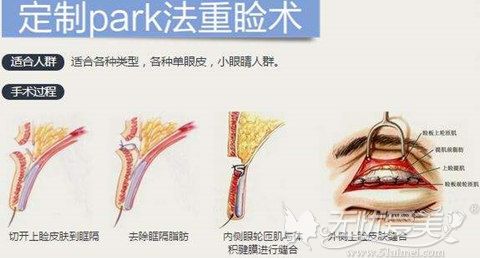 台州恩璨整形Park法双眼皮手术过程