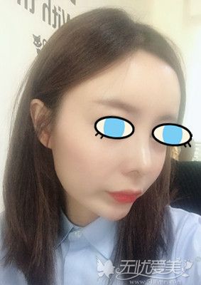 韩国碧夏隆鼻+自体脂肪填充术后50天
