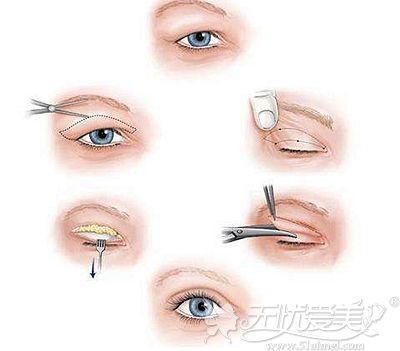传统全切双眼皮手术的原理