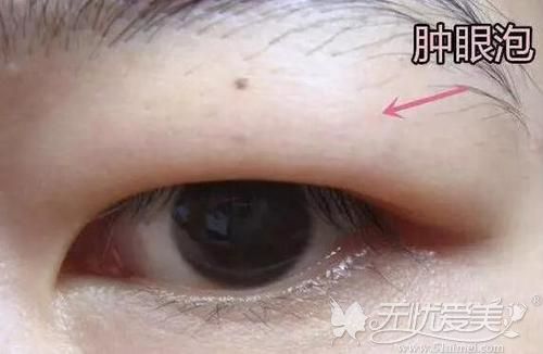 苏州华美针对肿泡眼的双眼皮手术