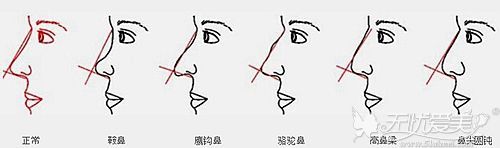 隆鼻选择通辽德尔美客鼻综合可以改善你的歪鼻、鹰钩鼻等