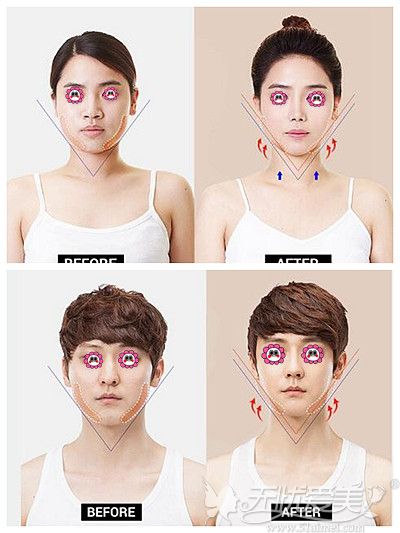 韩国ID面部轮廓手术案例
