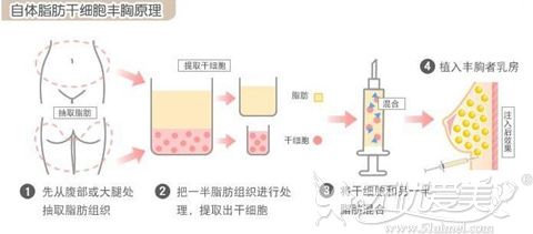 自体脂肪丰胸原理