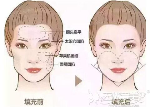 重磅!北京美莱新品脂肪技术面部轮廓塑形在8月23日首发