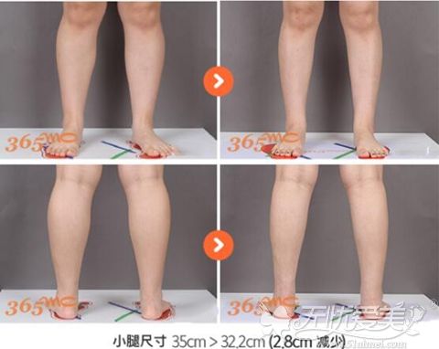 韩国365mc小腿吸脂手术案例
